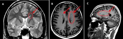 Grey Matter Heterotopia and Criminal Responsibility in a Case of Personal Injury Defense